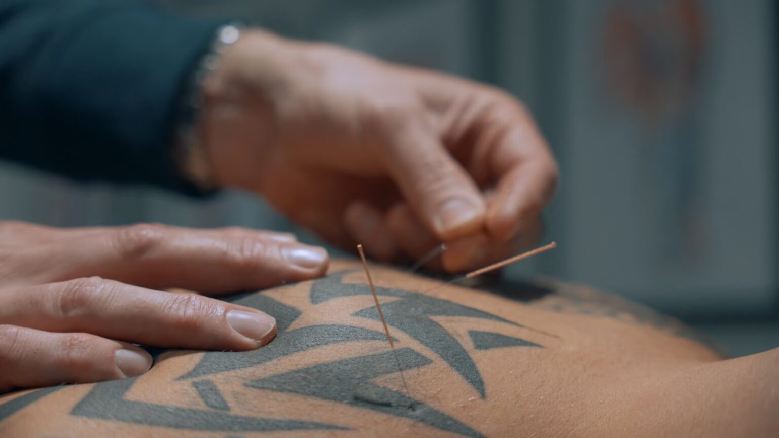 acupuncture-on-back_converted